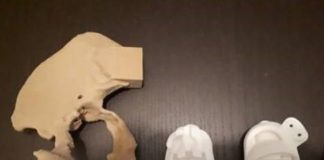 Protesi all’anca in 3d impiantata a Ferrara