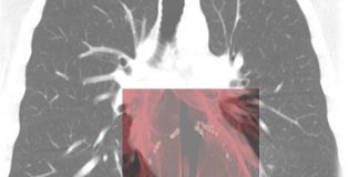 Coronavirus, intelligenza artificiale in campo per calcolare il rischio