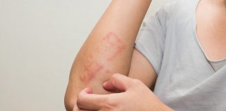 Psoriasi, un corto per superare vergogna, depressione e isolamento