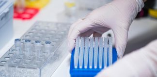 Covid, rischio diabete correlato al virus