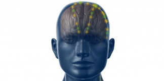 Medtronic, nuovo ‘pacemaker’ cerebrale anti-Parkinson