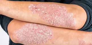 In Italia 1,5 mln persone con psoriasi, per Giornata mondiale campagna social