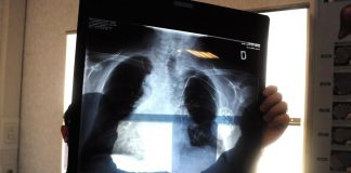 Esperto: “Iter frammentato diagnosi cancro polmone crea errori”