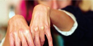 L’oncologo: “Il 30-50% pazienti è malnutrito o a rischio malnutrizione”