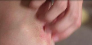 Psoriasi, identificati i fattori di rischio scatenanti