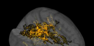 Covid, dopo forme gravi rischio depressione e alterazioni cervello