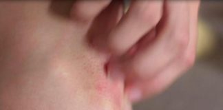 Salute: 2,5 mln italiani convivono con psoriasi e artrite psoriasica