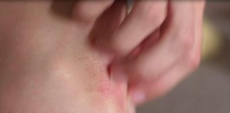 Corazza (Apiafco): ‘Alleanza psoriasi per inserire malattia in Piano cronicità’