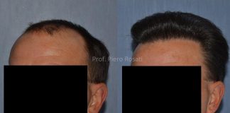 Il trapianto di capelli: un effetto più folto con la metodica CFU