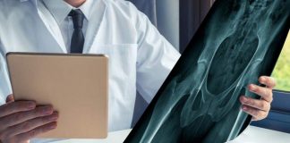 Ortogeriatria, parte il percorso al Poma per pazienti con frattura al femore