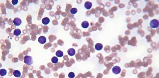 Leucemia linfatica cronica, ok dell’Aifa alla terapia per remissione in 1 anno