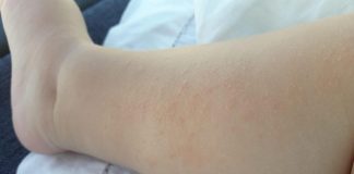 Dermatite atopica, in estate sotto controllo con gel facili da spalmare