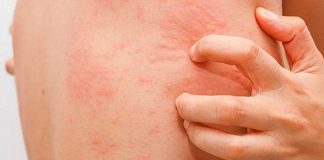 Orticaria, quello che i pazienti non dicono