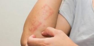 Dermatologo Bardazzi, ‘facilitare diagnosi psoriasi con la regola del 10’