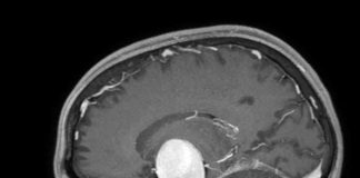 Milano, aneurisma gigante rimosso dal cervello di una 24enne