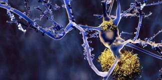 Alzheimer, Roche conferma il suo impegno in ricerca e sviluppo