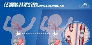Al Bambino Gesù riparato esofago a 5 neonati grazie a magneti