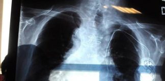 Fibrosi polmonari, diagnosi ancora difficile per pazienti con ‘fiato corto’