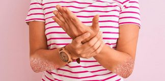 Artrite psoriasiaca, ok dell’Aifa alla rimborsabilità del monoclonale di AbbVie