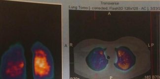 Long Covid, la storia di Marta: “Sto male da 3 anni. In tanti lottiamo per riprendere vita e lavoro”