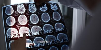 Alzheimer a 19 anni, segnalato caso più precoce al mondo