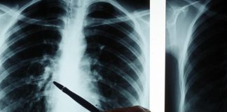 “Tubercolosi in ripresa, ricomincia a fare paura”