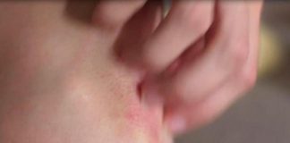 Psoriasi, in aumento le terapie per una migliore gestione della malattia