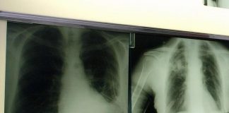 Tumori, cancro del polmone in stadio precoce: con nuova terapia 88% pazienti vivo a 5 anni