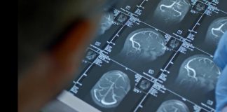 Sclerosi multipla, Aifa approva rimborsabilità per monoclonale sottocute