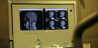 Covid, disturbi neurologici oggi rari ma in 30% casi durati più di 6 mesi