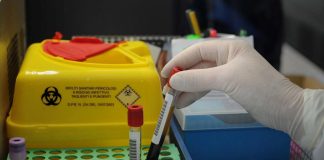 Dermatologo Rossi, ‘alopecia areata nei Lea, spia di altre patologie autoimmuni’