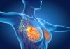 Cancro seno in stadio precoce, farmaco riduce del 32% rischio recidiva a 5 anni