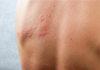Dardani (Sir): “Herpes Zoster più rischioso per pazienti reumatologici”