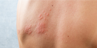 Dardani (Sir): “Herpes Zoster più rischioso per pazienti reumatologici”