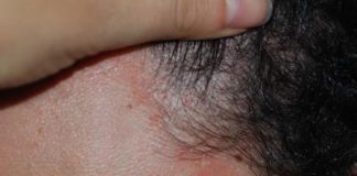 Costanzo (Humanitas): “Jak inibitori utili in comorbidità di dermatite atopica”