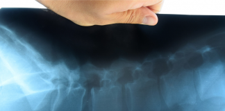 Ucb, dati positivi bimekizumab a 5 anni contro spondilite anchilosante