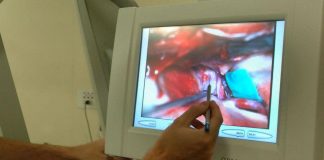 Ricerca: scoperta nuova causa aneurismi dell’aorta toracica