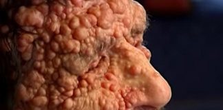 Neurofibromatosi, il morbo che deturpa il volto: ecco la malattia che ha commosso il Papa