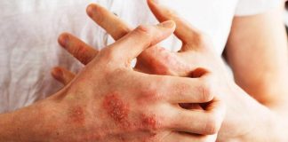 Psoriasi a placche, studio conferma efficacia terapia orale deucravacitinib