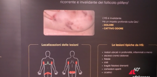 Idrosadenite suppurativa, l’esperto: “Più attenzione a qualità della vita”