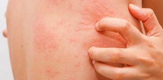 Fake news sull’orticaria, l’immunologo: “Diffidare dai test farlocchi”