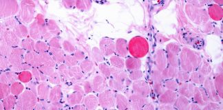 Distrofia Duchenne, via italiana per riparare e rigenerare i muscoli