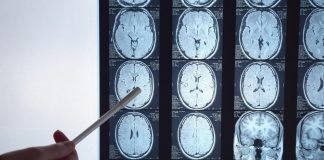 Tumori, per glioblastoma nuove prospettive da immunoterapia personalizzata