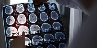 Da test precoci a nuove terapie, corrono studi su Alzheimer