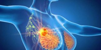 Cancro seno avanzato, cambia pratica clinica nella lotta a metastasi cerebrali