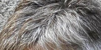 Psoriasi cuoio capelluto, nuovi studi confermano efficacia deucravacitinib
