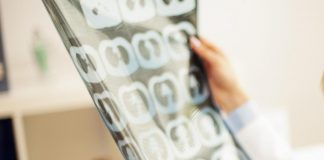 Alzheimer, associazioni dei pazienti a leader G7: “La demenza è una sfida mondiale”