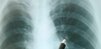 Tbc torna minaccia numero 1, mai così tanti casi: report Oms