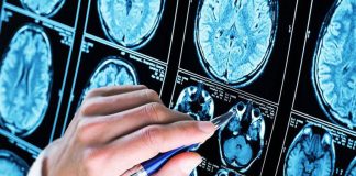 Farmaci, lecanemab: nuovi dati su benefici a lungo termine in Alzheimer iniziale