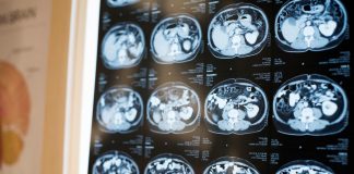 Alzheimer, Ema ci ripensa e dice sì al lecanemab